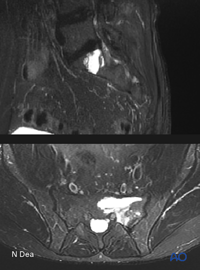 Intralesional resection (S1 to S5) for Benign sacral tumors