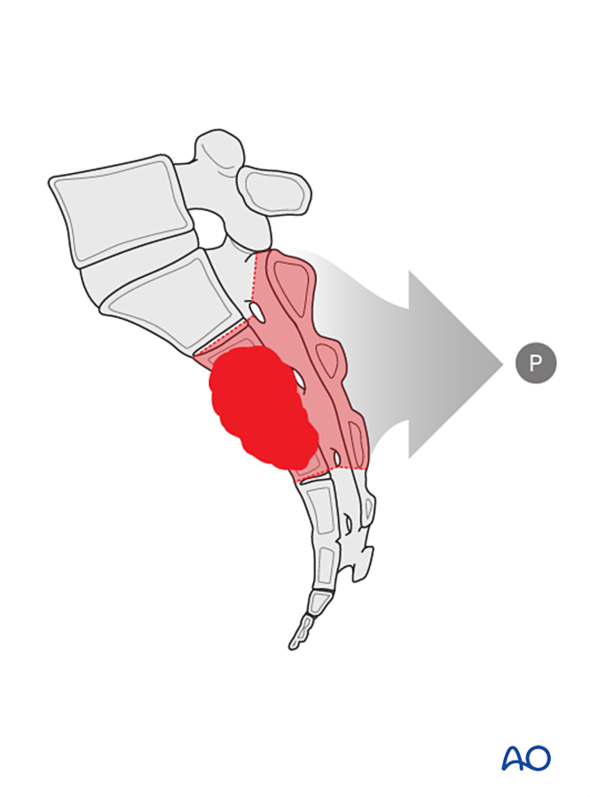 Intralesional resection (S1 to S5) for Benign sacral tumors