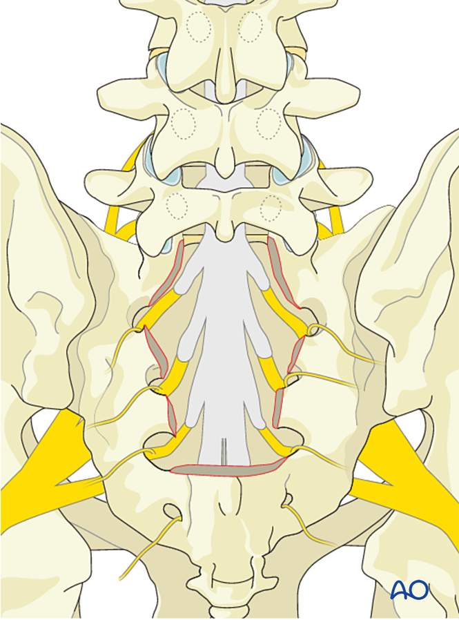 Intralesional resection (S1 to S5) for Benign sacral tumors