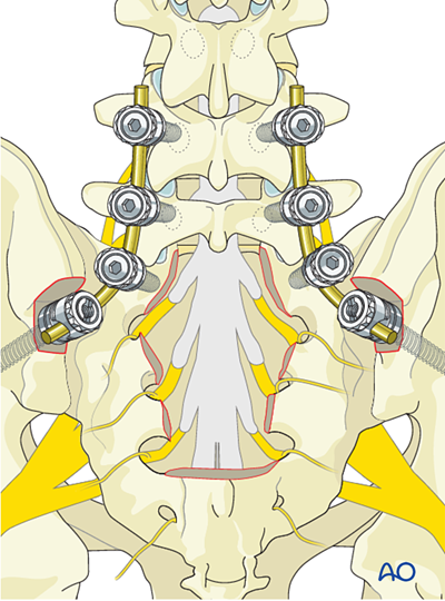 Intralesional resection (S1 to S5) for Benign sacral tumors