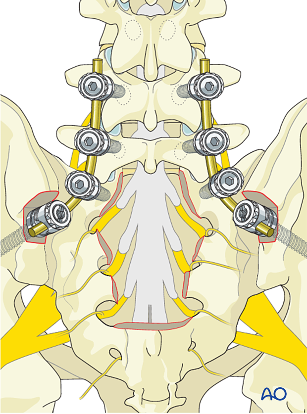 Reconstruction strategy during intralesional resection S1 to S5