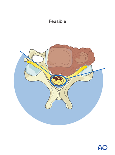 En bloc resection of an anterior tumor (C1 to C7) for Benign cervical ...