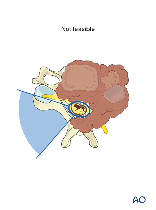 Enlarge the tumor below until the red line (reduce the blue zone)