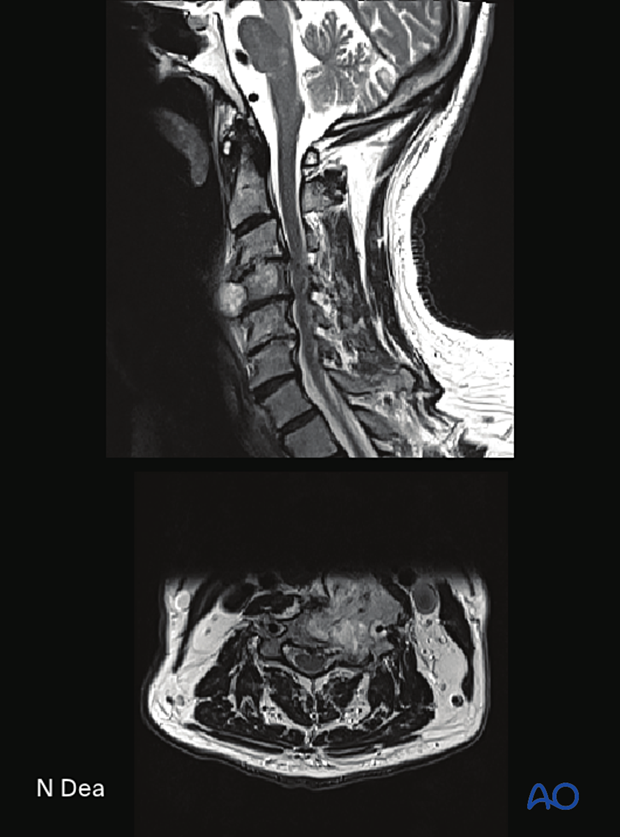 MRI images of tumor of cervical spine