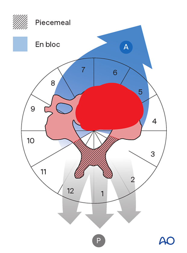 Strategy for en bloc resection with anterior reconstruction C1 to C7