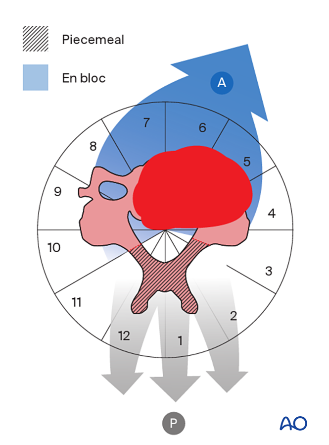 En bloc resection of an anterior tumor (C1 to C7) for Benign cervical ...