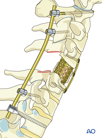 En bloc resection of an anterior tumor (C1 to C7) for Benign cervical ...