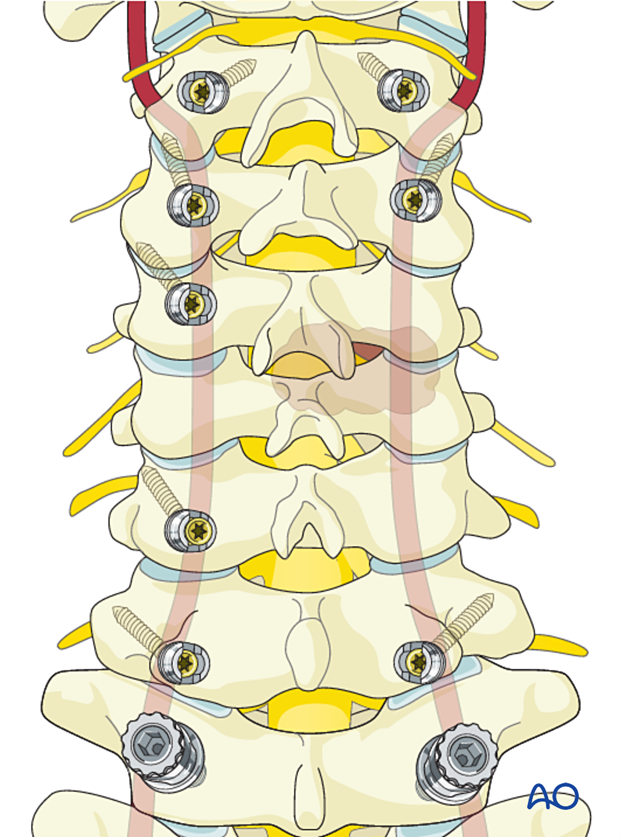 Screw insertion during en bloc resection C1 to C7