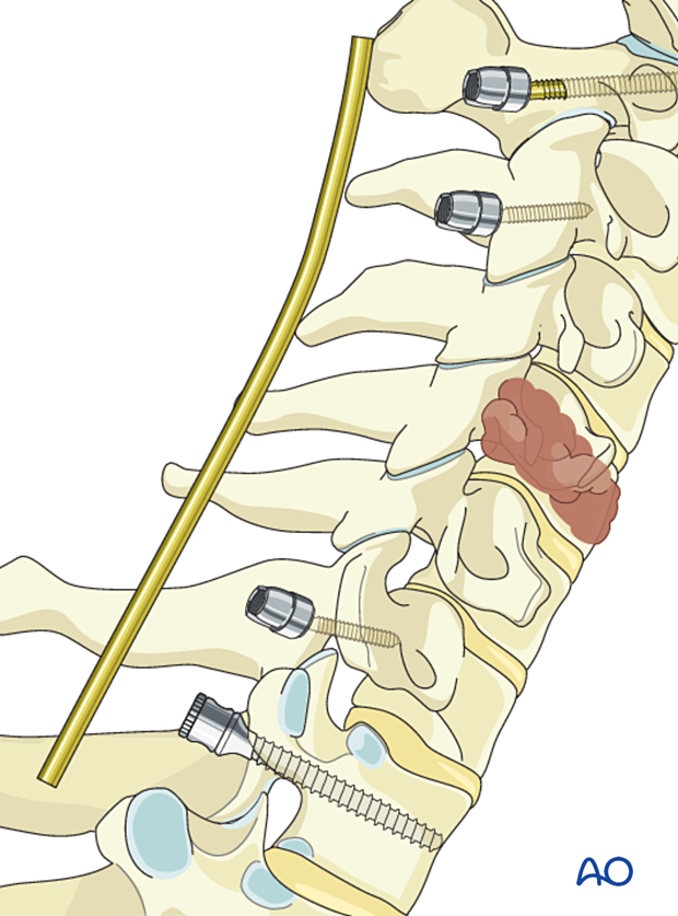 Rod contouring during en bloc resection C1 to C7