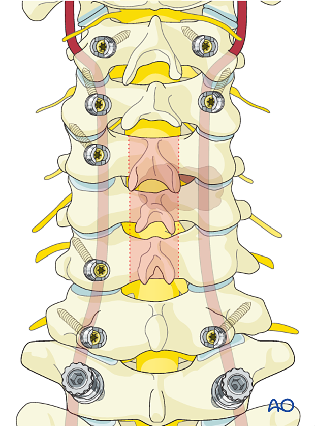 56b P410 En bloc resection with anterior reconstruction C1 to C7