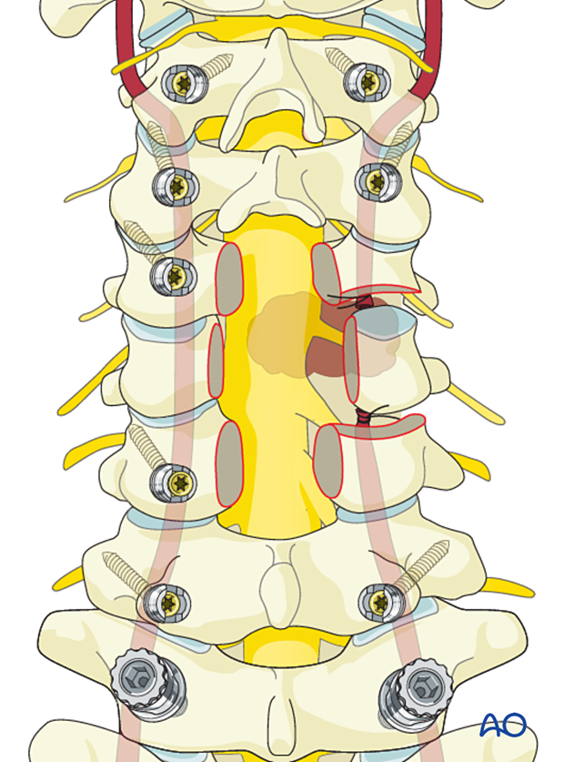 Vertebral artery ligation during en bloc resection C1 to C7