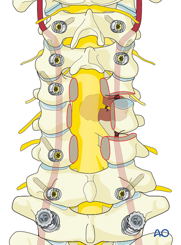 Nerve ligation during en bloc resection C1 to C7