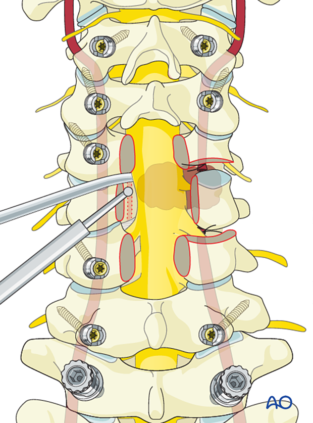 Contralateral dissection during en bloc resection C1 to C7