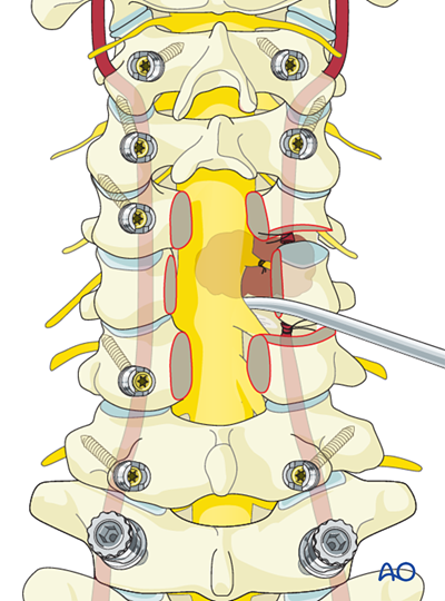 En bloc resection of an anterior tumor (C1 to C7) for Benign cervical ...