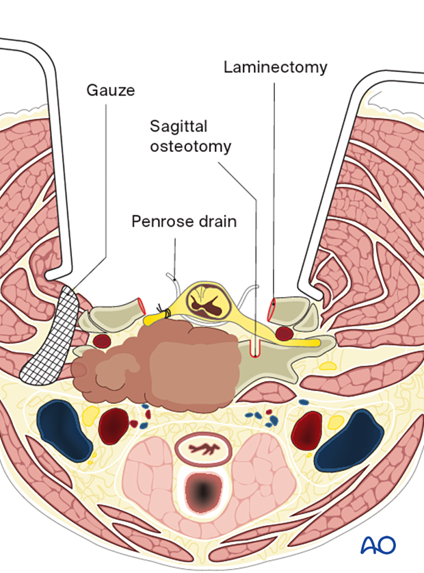 Facilitating anterior dissection during en bloc resection C1 to C7