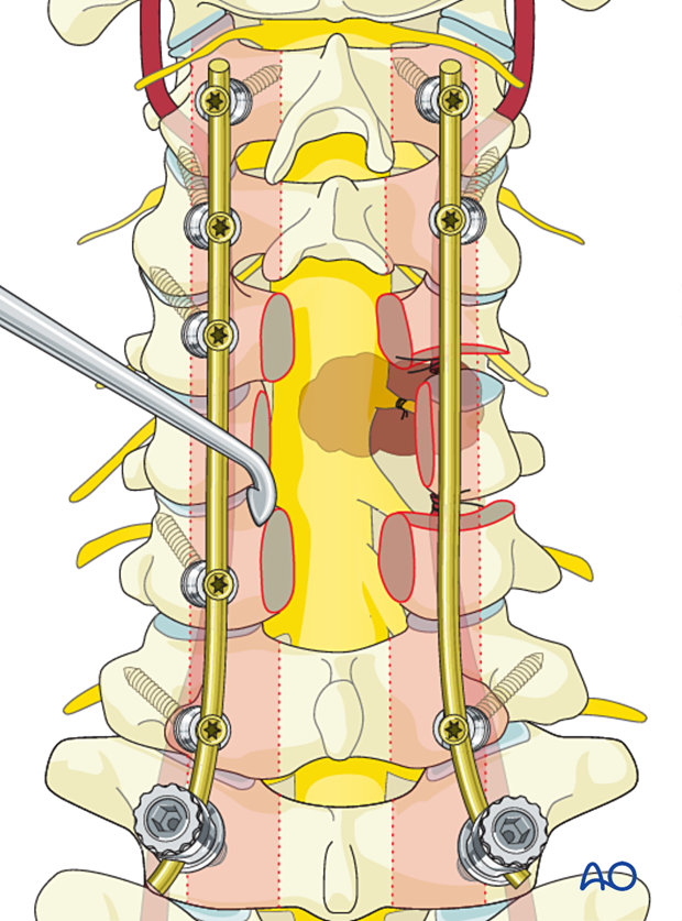 Preparation for fusion during en bloc resection C1 to C7