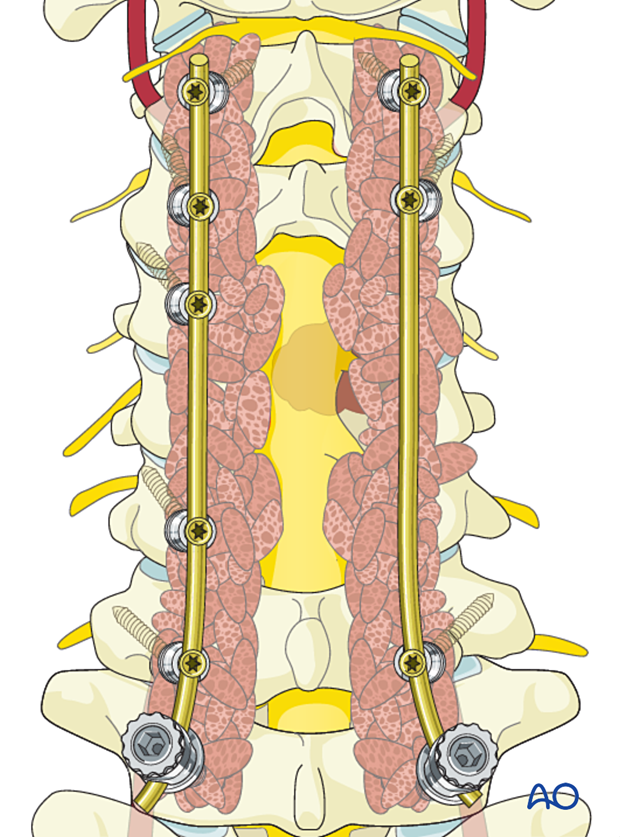 Grafting during en bloc resection C1 to C7