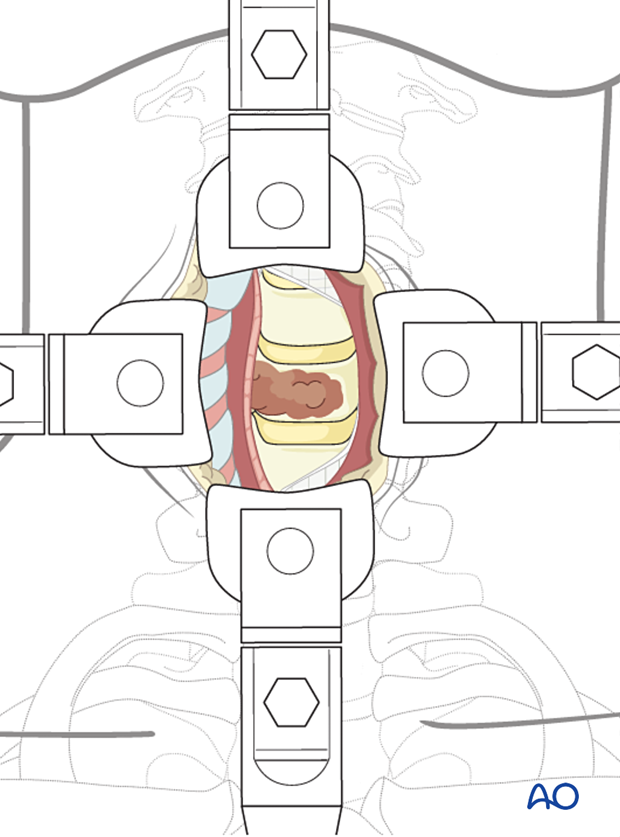 Anterior access to the cervical spine