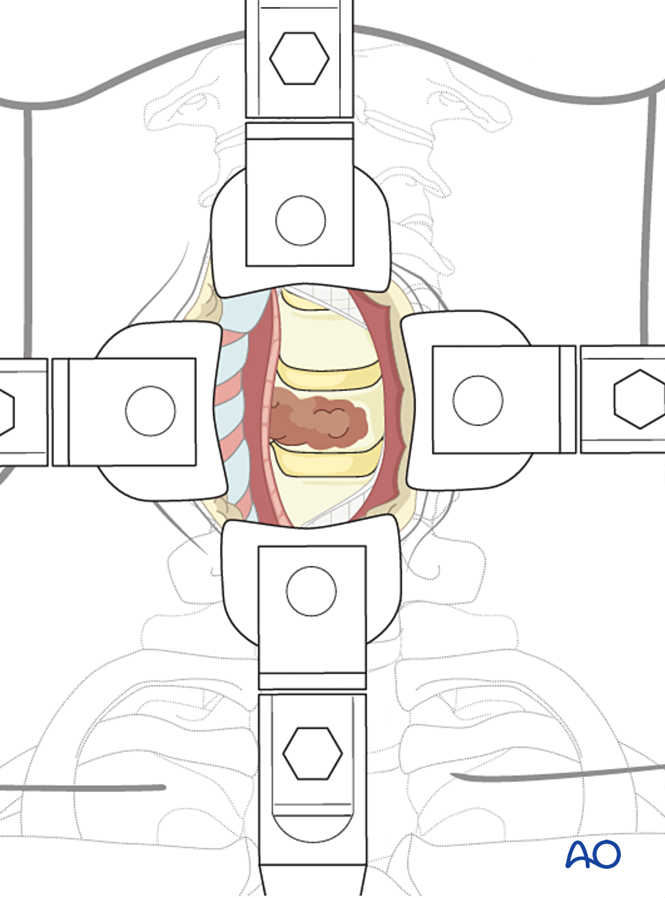 En bloc resection of an anterior tumor (C1 to C7) for Benign cervical ...
