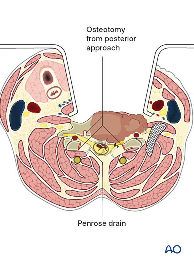 Tumor delivery during en bloc resection C1 to C7