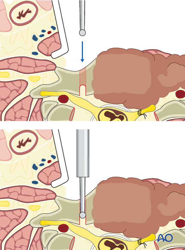 Completing C5 sagittal osteotomy during en bloc resection 