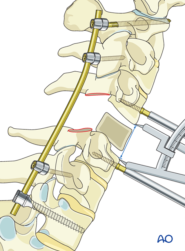 Measuring the resection defect during en bloc resection C1 to C7