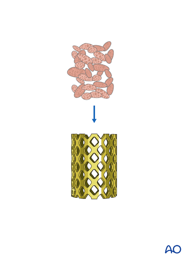 Filling a mesh cage with grafting material