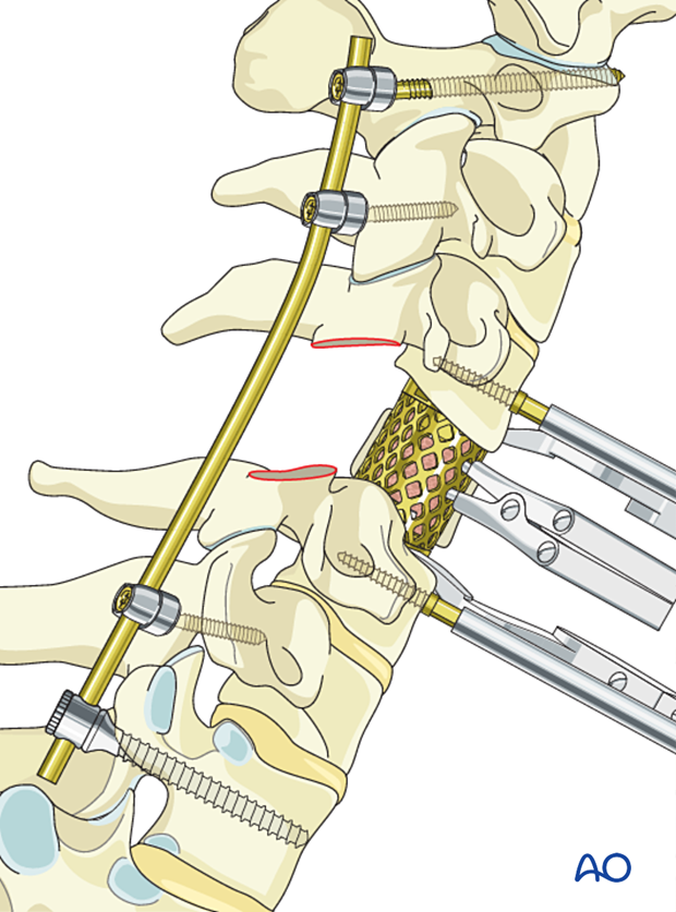 Inserting a mesh cage during en bloc resection C1 to C7