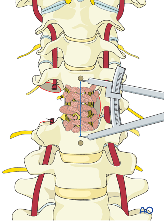 Anterior plating during en bloc resection C1 to C7