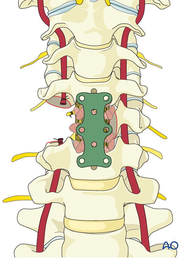 Positioning plate during en bloc resection C1 to C7