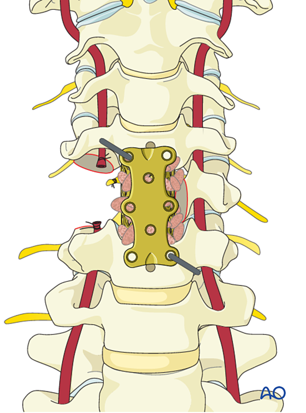 Adjusting position of plate during en bloc resection C1 to C7