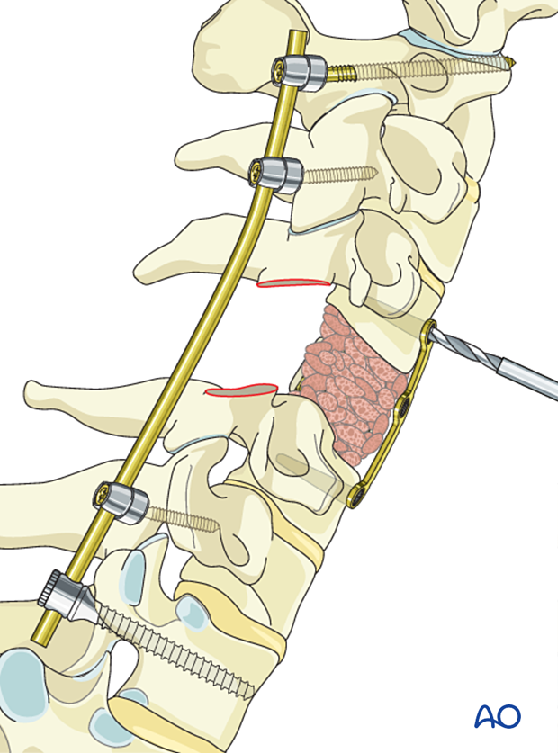 Preparing screw holes for plate during en bloc resection C1 to C7