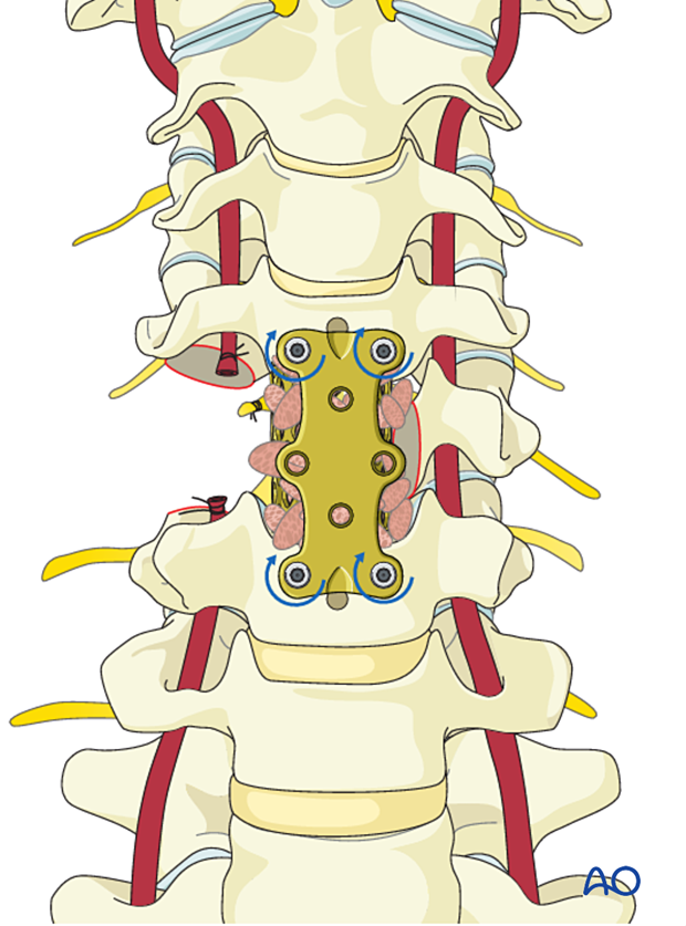 Final hardware positioning during en bloc resection C1 to C7