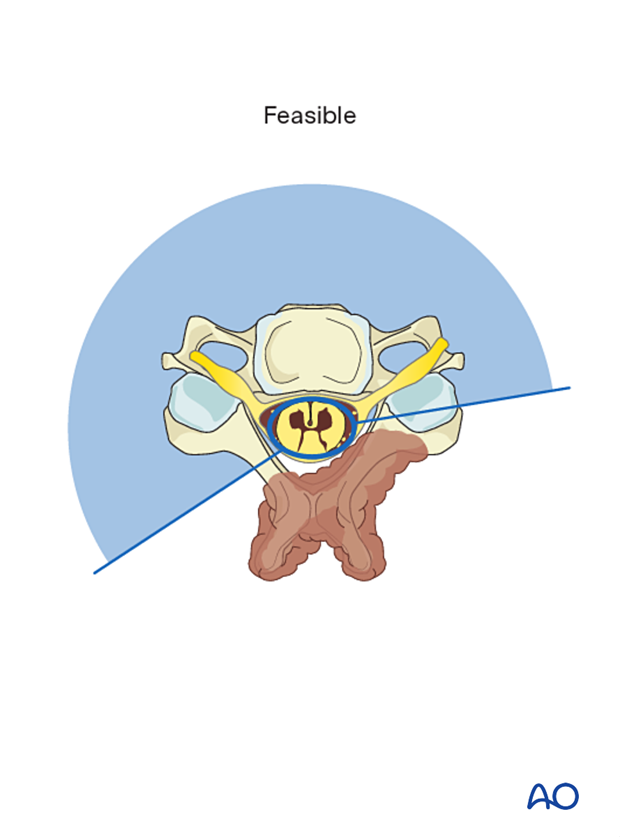 Feasible en bloc resection of primary tumor in the cervical spine