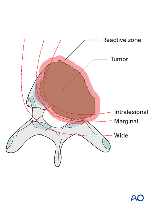 56b P415 En bloc resection C1 to C7