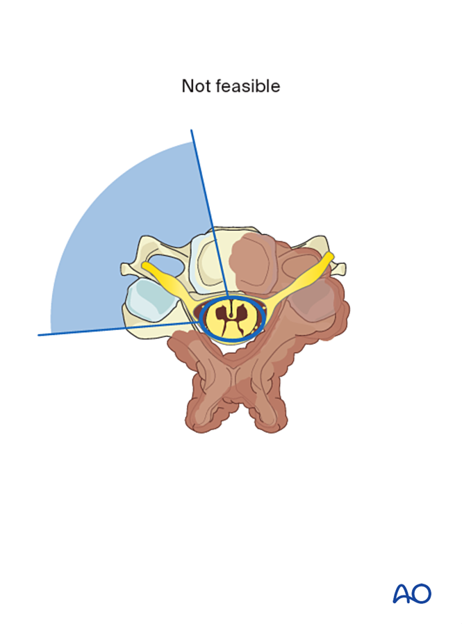En bloc resection of a posterior tumor (C1 to C7) for Benign cervical ...