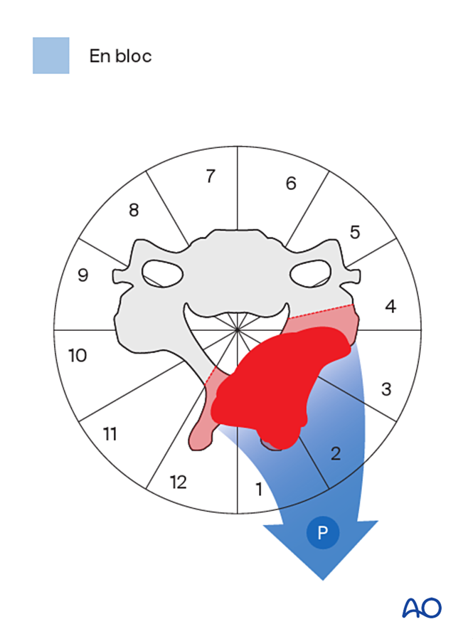 En bloc resection of a posterior tumor (C1 to C7) for Benign cervical ...