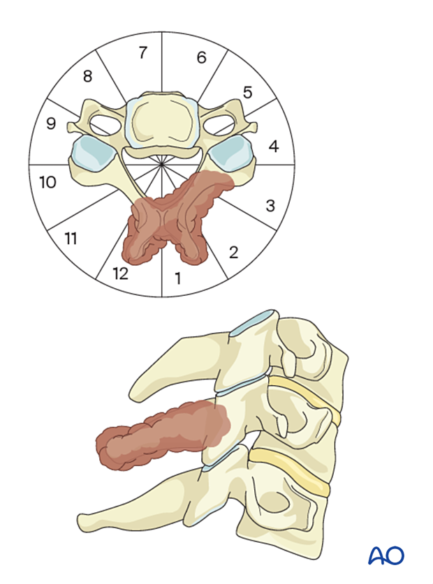 En bloc resection of C5 primary tumor located in segments 12–3 of the WBB classification