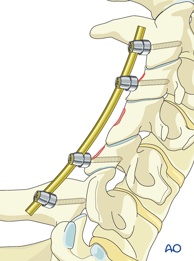 Reconstruction strategy during en bloc resection of primary tumor in the cervical spine