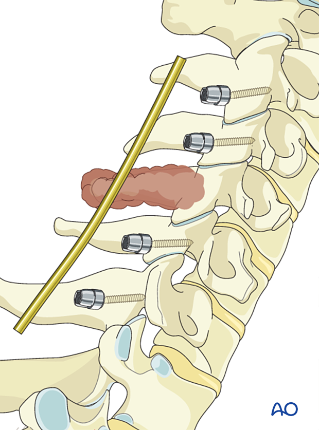 Rod contouring during en bloc resection of primary tumor in the cervical spine