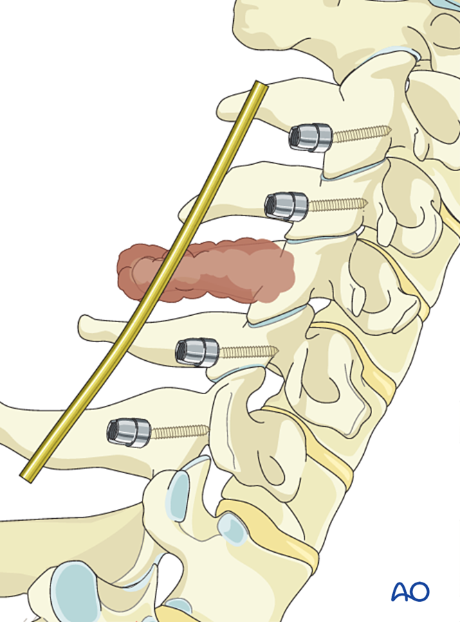 En bloc resection of a posterior tumor (C1 to C7) for Benign cervical ...