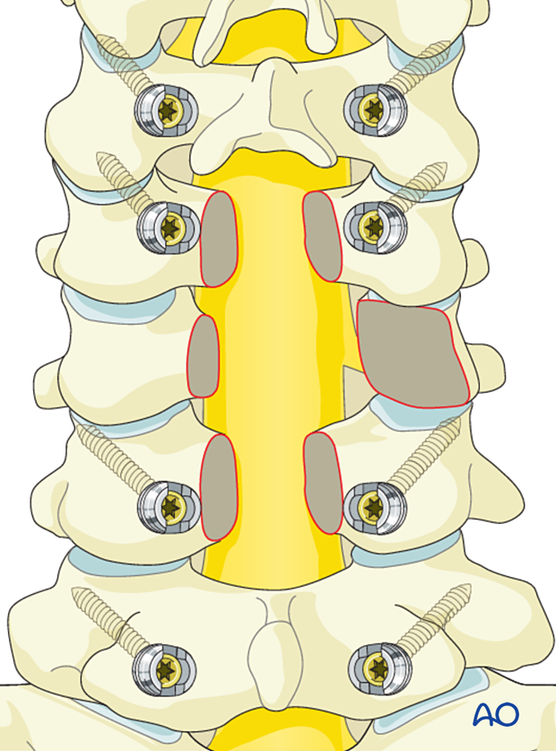 T|umor delivery during en bloc resection of primary tumor in the cervical spine