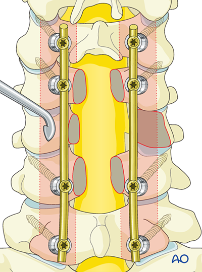 En bloc resection of a posterior tumor (C1 to C7) for Benign cervical ...