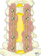 Insertion of bone graft during en bloc resection of primary tumor in the cervical spine