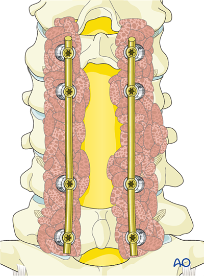 En bloc resection of a posterior tumor (C1 to C7) for Benign cervical ...