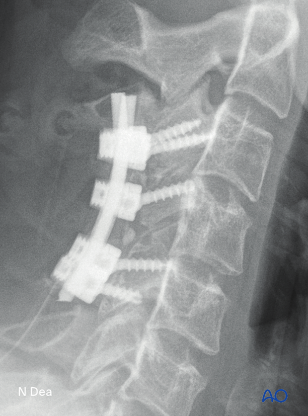 Intraoperative image (lateral view) after en bloc resection of primary tumor in the cervical spine showing position of rods and screws