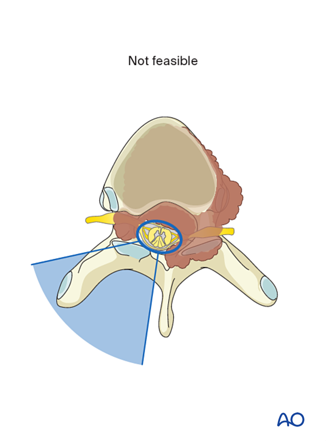 En bloc resection of an anterior tumor (T1 to T12) for Malignant ...