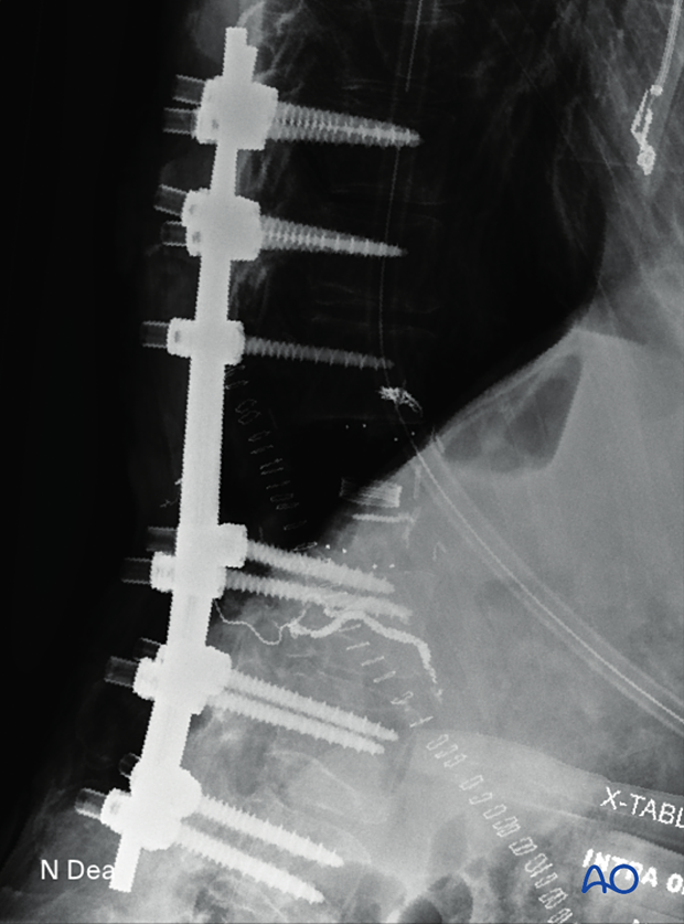 Intraoperative image (lateral view) after en bloc resection of an anterior tumor T1-T12, showing position of screws, rods, and expandable prosthesis.