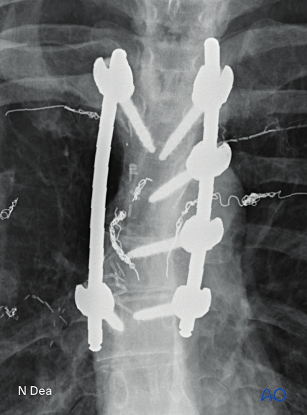 Intraoperative AP image during en bloc resection of primary posterior thoracic tumor showing position of screws and rods 