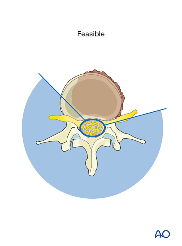 Primary lumbar tumor feasible for en bloc resection with posterior release and anterior tumor delivery
